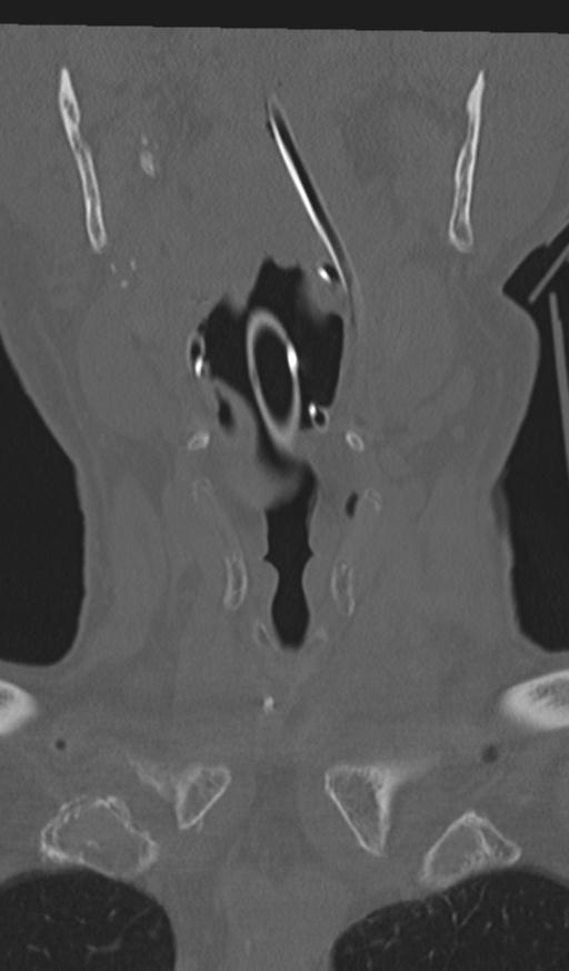 Acute on chronic subdural hematoma and thoracic vertebral injury in a multitrauma patient (Radiopaedia 31698-32619 Coronal bone window 2).jpg