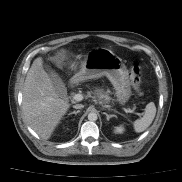 Acute pancreatitis (Radiopaedia 26663-26813 Axial C+ portal venous phase 23).jpg