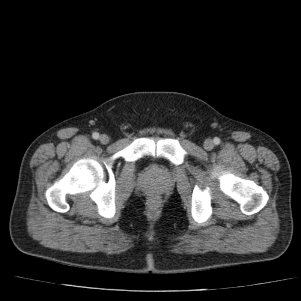 Acute pancreatitis (Radiopaedia 26663-26813 Axial C+ portal venous phase 87).jpg