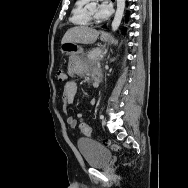 Acute pancreatitis (Radiopaedia 26663-26813 Sagittal C+ portal venous phase 44).jpg