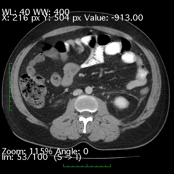 Acute pancreatitis (Radiopaedia 34043-35276 Axial C+ portal venous phase 53).jpg