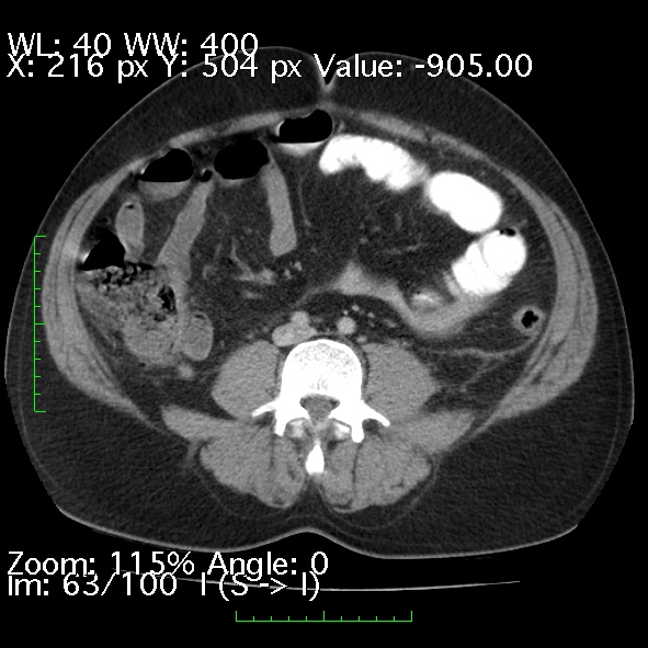 File:Acute pancreatitis (Radiopaedia 34043-35276 Axial C+ portal venous phase 63).jpg