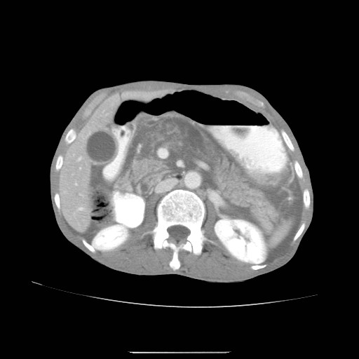File:Acute pancreatitis (Radiopaedia 50213-55558 Axial C+ portal venous phase 15).jpg