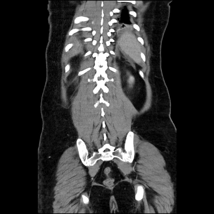 Acute pancreatitis (Radiopaedia 69236-79012 Coronal C+ portal venous phase 22).jpg