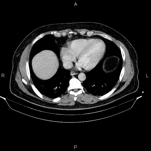 File:Acute pancreatitis (Radiopaedia 85390-101010 Axial C+ portal venous phase 7).jpg
