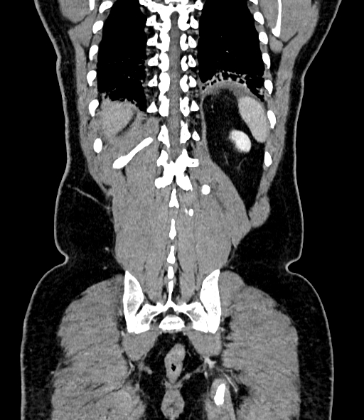 Acute pancreatitis (Radiopaedia 87428-103757 Coronal C+ portal venous phase 77).jpg