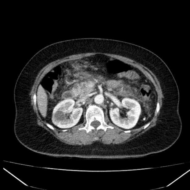 Acute pancreatitis - Balthazar C (Radiopaedia 26569-26714 Axial C+ arterial phase 35).jpg