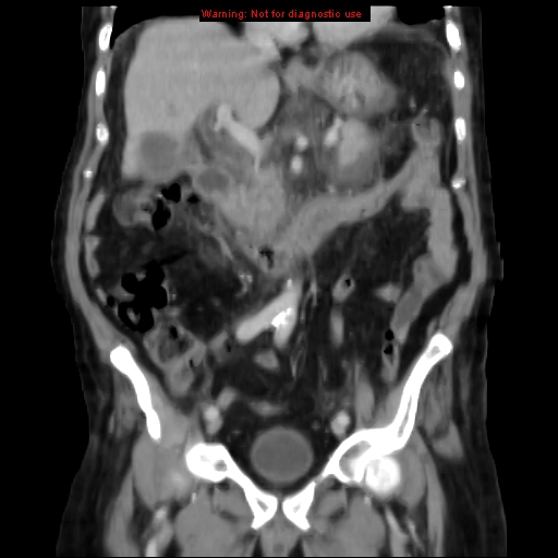 Acute pancreatitis with incidental pancreatic lipoma (Radiopaedia 10190-10730 Coronal C+ portal venous phase 32).jpg