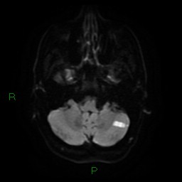 Acute posterior cerebral artery territory infarct (Radiopaedia 79329-92394 Axial DWI 7).jpg