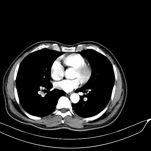 Acute pulmonary embolism (Radiopaedia 69510-79390 D 37).jpg