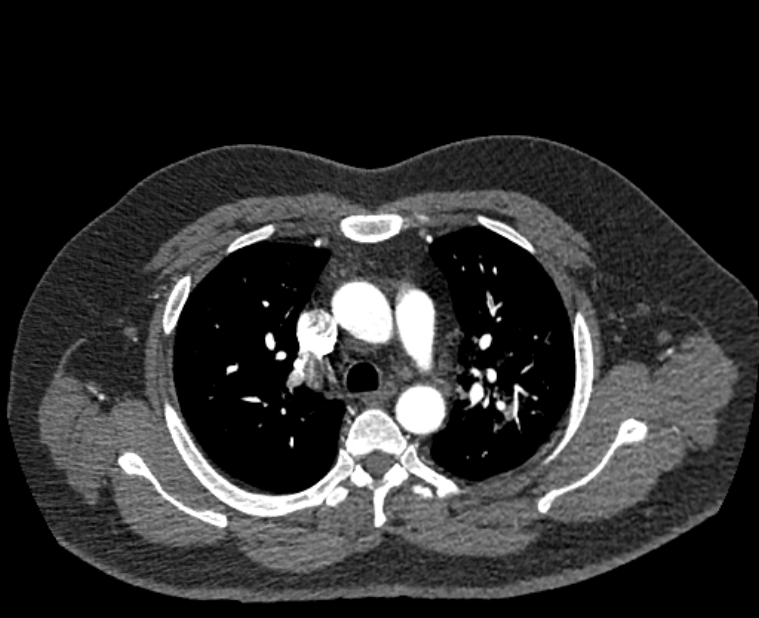 Acute pulmonary embolism with pulmonary infarcts (Radiopaedia 77688-89908 Axial C+ CTPA 19).jpg