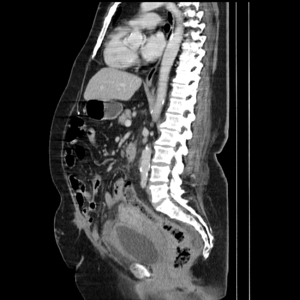 Acute pyelonephritis (Radiopaedia 25657-25837 Sagittal renal parenchymal phase 44).jpg