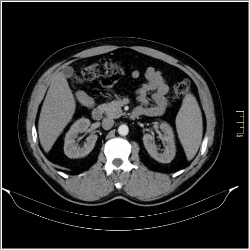 Acute right sided diverticulitis (Radiopaedia 65249-74268 Axial C+ portal venous phase 28).JPG
