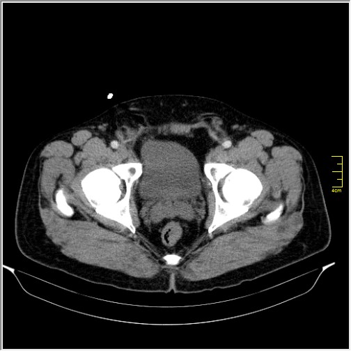 Acute right sided diverticulitis (Radiopaedia 65249-74268 Axial C+ portal venous phase 76).JPG