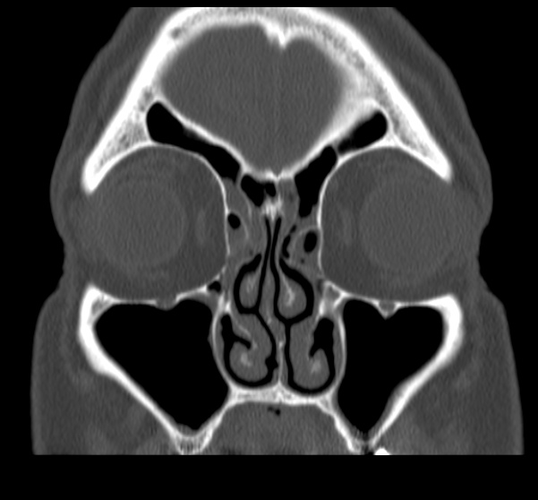 Acute sinusitis (Radiopaedia 23161-23215 Coronal bone window 28).jpg