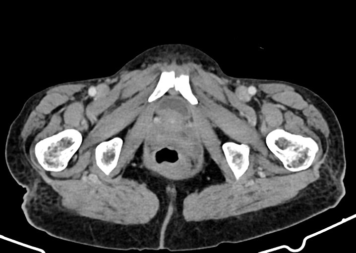 Acute small bowel (ileal) volvulus (Radiopaedia 71740-82139 Axial C+ portal venous phase 202).jpg