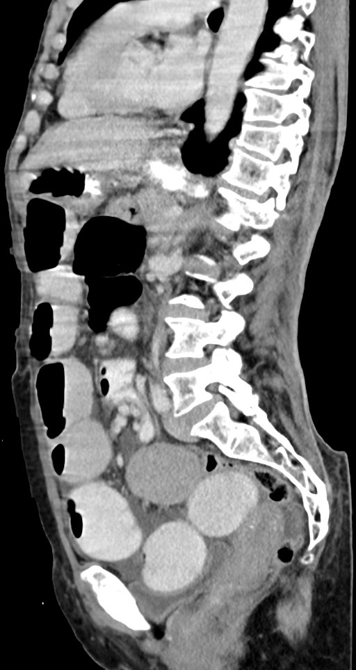 Acute small bowel (ileal) volvulus (Radiopaedia 71740-82139 Sagittal C+ portal venous phase 78).jpg