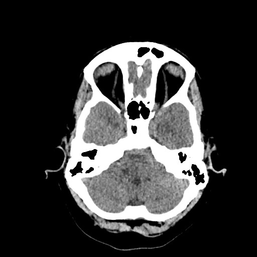 Acute subarachnoid hemorrhage and accessory anterior cerebral artery (Radiopaedia 69231-79008 Axial non-contrast 12).jpg