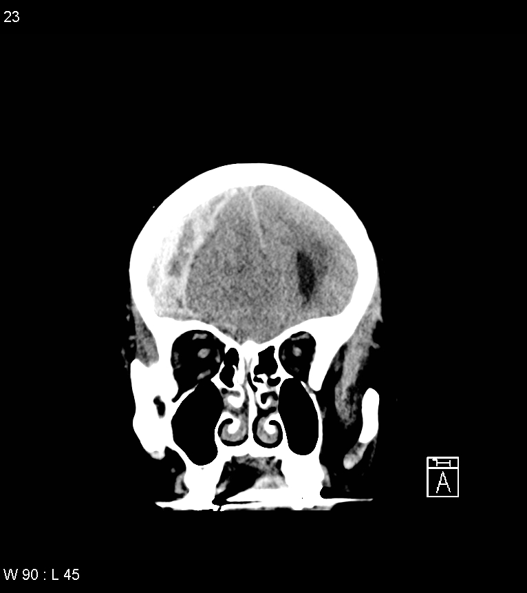 Acute subdural hematoma with myelofibrosis (Radiopaedia 52582-58494 Coronal non-contrast 14).jpg
