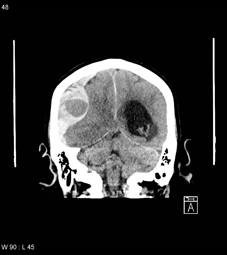 Acute subdural hematoma with myelofibrosis (Radiopaedia 52582-58494 Coronal non-contrast 39).jpg