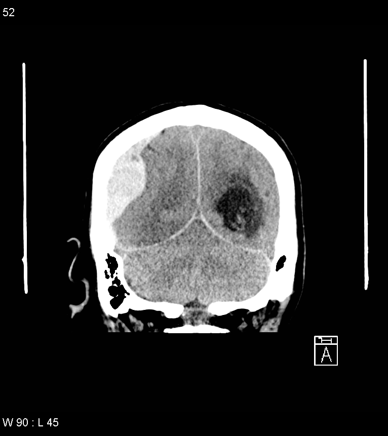 Acute subdural hematoma with myelofibrosis (Radiopaedia 52582-58494 Coronal non-contrast 43).jpg