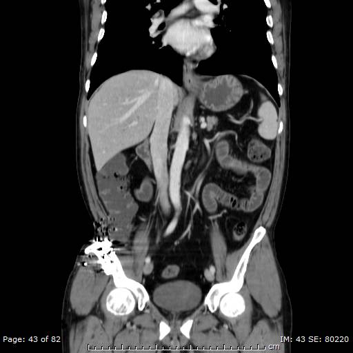 Acute superior mesenteric artery occlusion (Radiopaedia 43636-47060 Coronal C+ portal venous phase 28).jpg