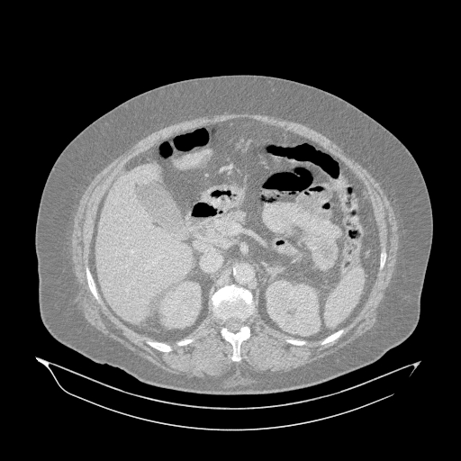Acute superior mesenteric artery occlusion (Radiopaedia 51288-56960 Axial lung window 13).jpg