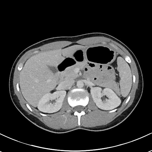 File:Acute uncomplicated appendicitis (Radiopaedia 61374-69304 Axial C+ portal venous phase 35).jpg