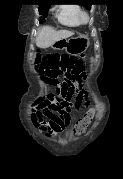 Adenocarcinoma of cecum (Radiopaedia 59222-66549 Coronal C+ portal venous phase 8).jpg