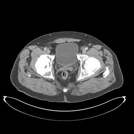 Adenocarcioma of rectum- T1 lesion (Radiopaedia 36921-38547 Axial C+ portal venous phase 84).png
