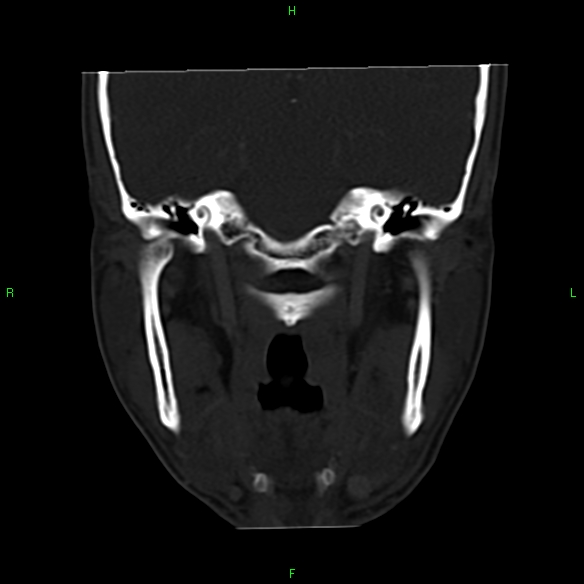 File:Adenoid cystic carcinoma of hard palate (Radiopaedia 26137-26273 Coronal bone window 22).jpg