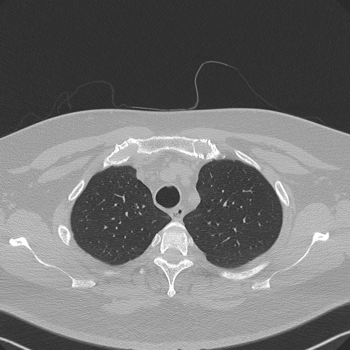 Adenoid cystic carcinoma of the trachea (Radiopaedia 49042-54137 Axial lung window 69).jpg