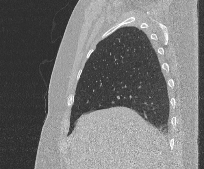 Adenoid cystic carcinoma of the trachea (Radiopaedia 49042-54137 Sagittal lung window 102).jpg