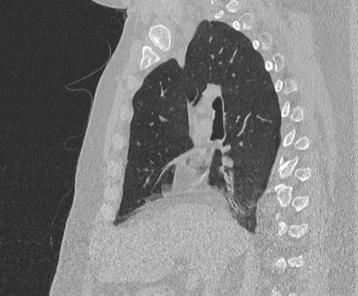 File:Adenoid cystic carcinoma of the trachea (Radiopaedia 49042-54137 Sagittal lung window 196).jpg