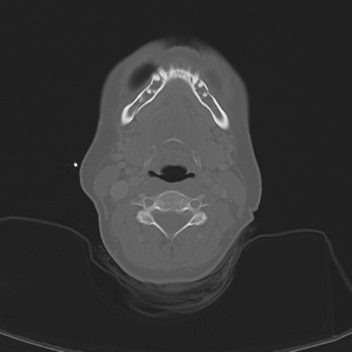 Adenoid cystic tumor of palate (Radiopaedia 46980-51518 Axial bone window 42).png