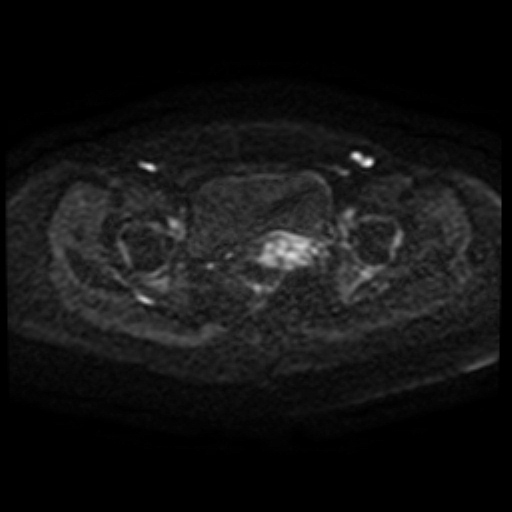 Adenoma malignum of cervix (Radiopaedia 66441-75705 Axial DWI 92).jpg