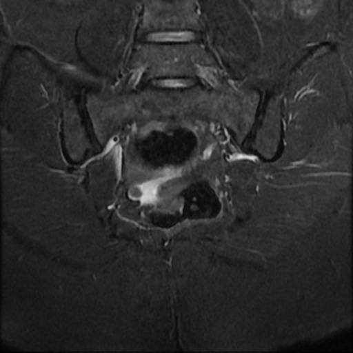 File:Adenoma malignum of cervix (Radiopaedia 66441-75705 Coronal STIR 19).jpg