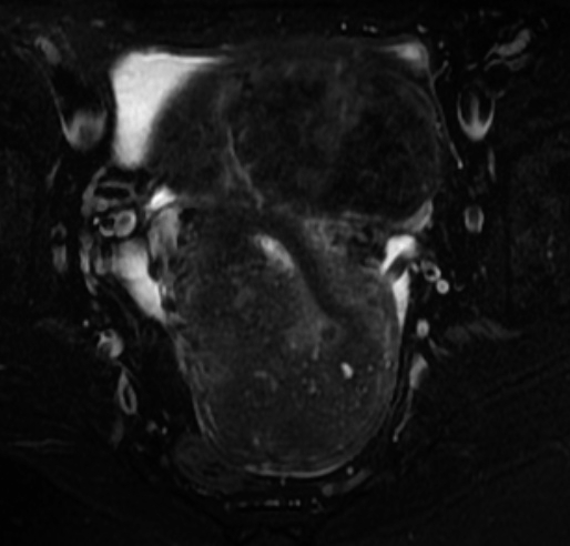 File:Adenomyosis and uterine fibroid (Radiopaedia 14161-14019 Axial T2 fat sat 1).jpg