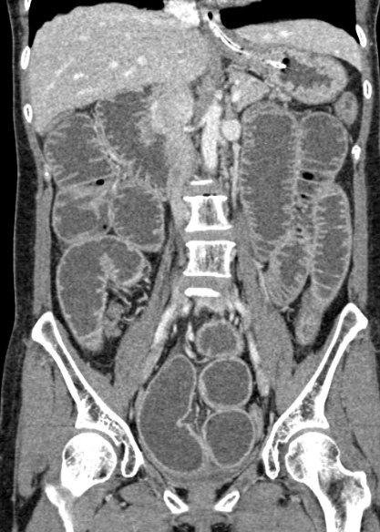 Adhesional small bowel obstruction (Radiopaedia 48397-53305 Coronal C+ portal venous phase 179).jpg