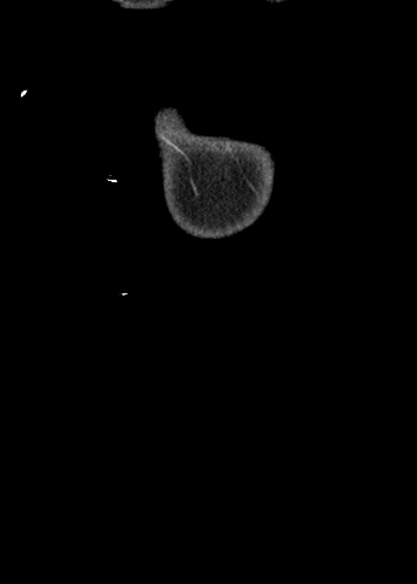 Adhesional small bowel obstruction (Radiopaedia 48397-53305 Coronal C+ portal venous phase 2).jpg