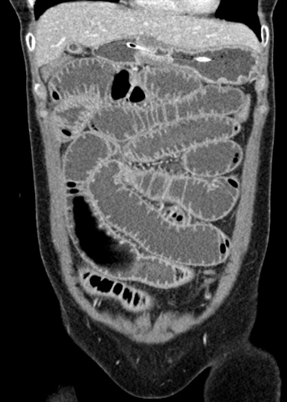 Adhesional small bowel obstruction (Radiopaedia 48397-53305 Coronal C+ portal venous phase 94).jpg