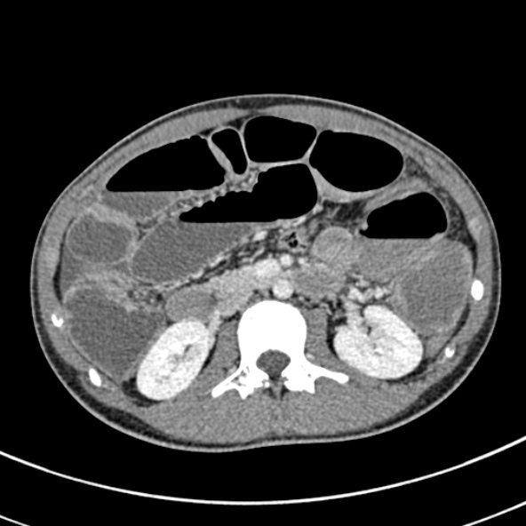 File:Adhesional small bowel obstruction (Radiopaedia 52107-57980 Axial C+ portal venous phase 48).jpg