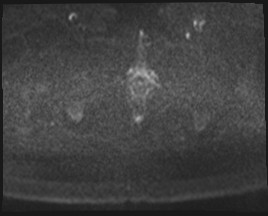Adnexal multilocular cyst (O-RADS US 3- O-RADS MRI 3) (Radiopaedia 87426-103754 Axial DWI 86).jpg