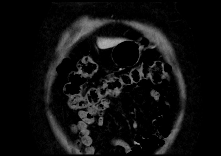 File:Adrenal cortical carcinoma (Radiopaedia 64017-72769 Coronal C+ portal venous phase 7).jpg