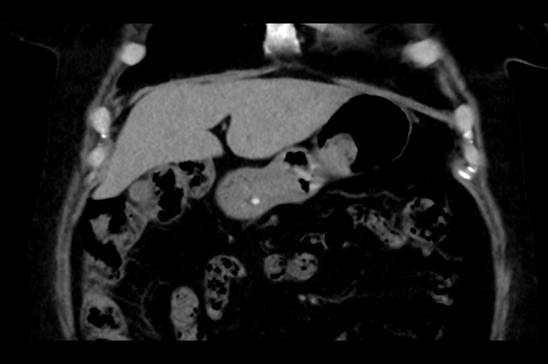 Adrenal cortical carcinoma (Radiopaedia 64017-72769 Coronal non-contrast 15).jpg