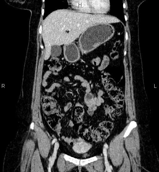 Adrenal cortical carcinoma (Radiopaedia 84882-100379 Coronal C+ portal venous phase 19).jpg