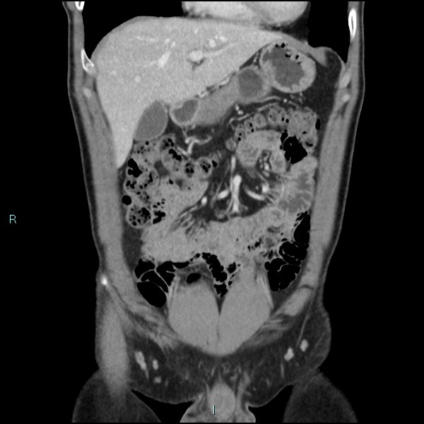 Adrenal cystic lymphangioma (Radiopaedia 83161-97534 Coronal C+ portal venous phase 22).jpg