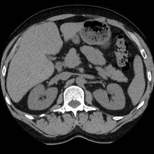 Adrenal gland trauma (Radiopaedia 81351-95079 Axial non-contrast 38).jpg