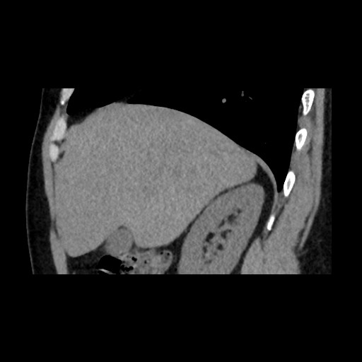 File:Adrenal gland trauma (Radiopaedia 81351-95079 Sagittal non-contrast 28).jpg