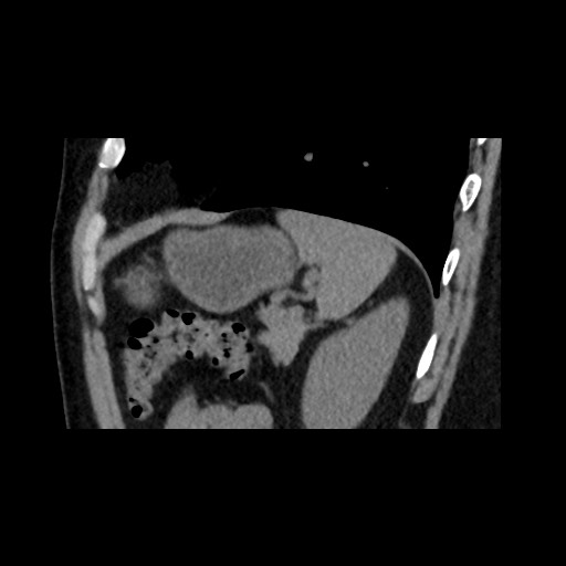 File:Adrenal gland trauma (Radiopaedia 81351-95079 Sagittal non-contrast 80).jpg